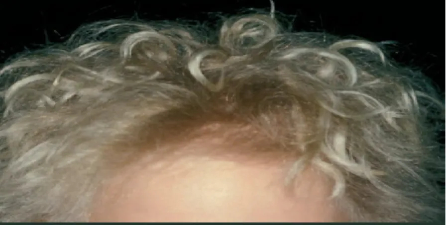 Figure 12 : Aspect caractéristique, ébouriffé, des « cheveux incoiffables » chez une  fillette de 6 ans