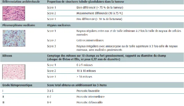 Tableau N°3 : grade histopronostique de Scarff Bloom Richardson modifié par Elston et Ellis