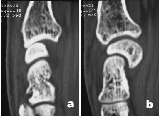 Figure 10 : Coupes TDM d’une désaxation SL associée à une arthrose stade 2 sur les radiographies