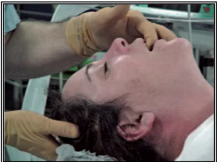 Figure 4 : La tête est maintenue en bonne position par la main de l’opérateur glissée  sous la tête du patient et la bouche du patient est ouverte avec le doigt en crochet [11]