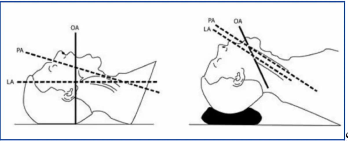 Figure 4 : position modifiée de Jackson pour optimiser la visualisation de larynx par  alignement des axes