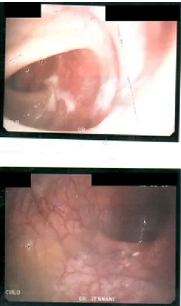 Figure 4. Images coloscopiques montrant des ulcérations aphtoïdes de la muqueuse -  Médecine C, CHU-Rabat 