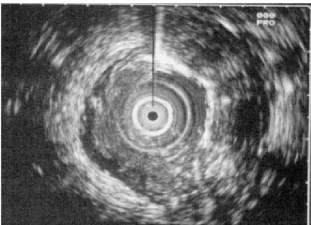 Figure 6 : Echoendoscopie rectale : épaississement de la paroi rectale. 