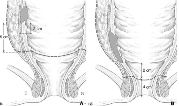 Figure 7 : A. Coupe frontale du rectum, tumeur de la moitié supérieure ; dissection  correcte extrafasciale avec section du rectum 5 cm sous le pôle inférieur de la tumeur
