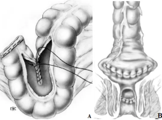 Figure 9 : A. Anastomose coloanale avec réservoir colique en J. B. Anastomose coloanale  avec coloplastie transversale [48]