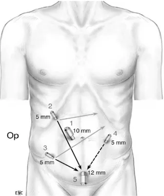 Figure 11 : Position des trocarts pour une résection du rectum par cœlioscopie [48]. 