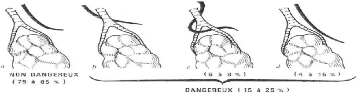 Figure 3: Les variations anatomiques du nerf laryngé supérieur et leur  