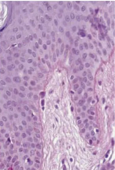 Fig. 4: Membrane basale après coloration de PAS   (periodic acid Schiff) (PAS ×400) 