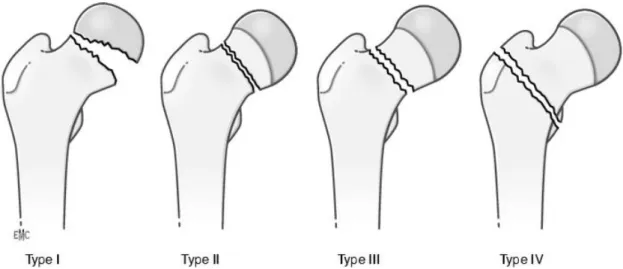 Fig 12:Classification selon Delbet des fractures du col fémoral chez l'enfant 