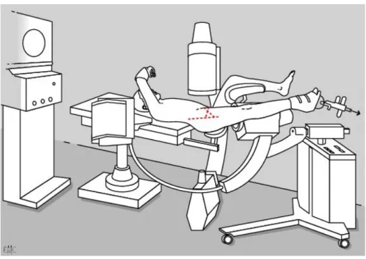 Fig 16: Installation sur table orthopédique 