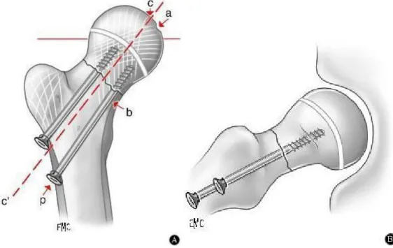 Fig. 20 : Principe du vissage, les vis respectent le cartilage de croissance.