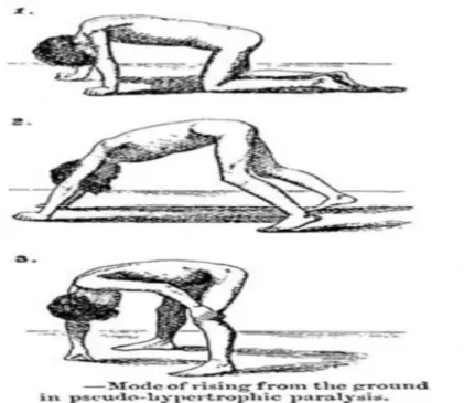 Figure 20: Dessins de Gowers d'un enfant atteint de dystrophie musculaire se levant du  sol