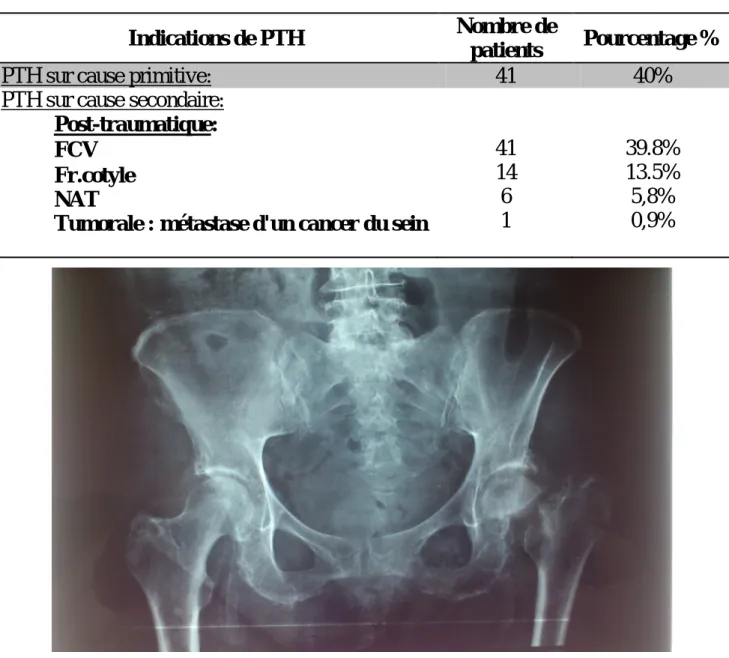 Tableau 3: Indications des PTH 
