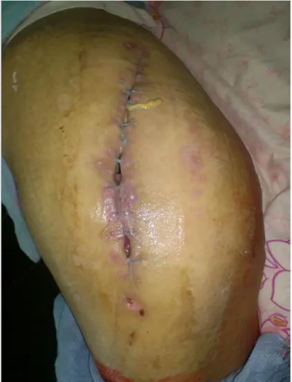 Figure 7: Image montrant une infection de la paroi sur PTH: 