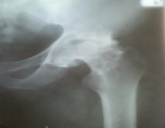 Fig 3:radiographie de la hanche droite de face :  Coxarthrose destructrice (obs.n°11) 