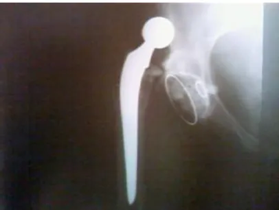 Fig 10 : Radiographie de la hanche gauche de face montrant une luxation  postérieure de PTH (obs :22) 