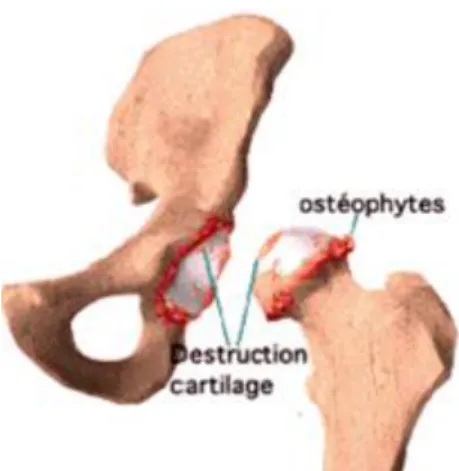 Fig 13 :radiographie du bassin et de la hanche gauche de face montrant une coxarthrose  primitive chez un patient de 73ans (obs.3) 