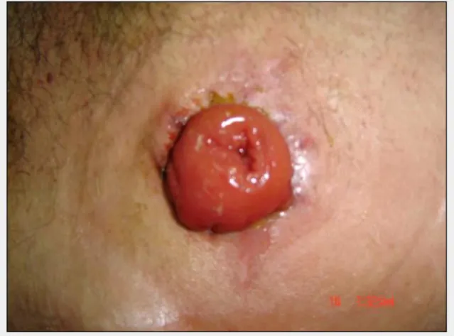 Figure 5 : photo d’une suppuration péristomiale autour d’une colostomie términale 