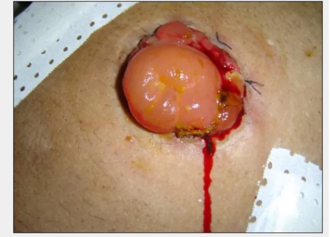 Figure 11 : photo d’une hémorragie stomiale précoce après colostomie. 