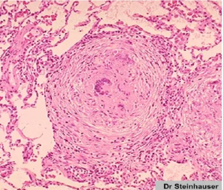 Figure 8: Granulome épithélio- giganto -cellulaire sans nécrose caséeuse [46] 