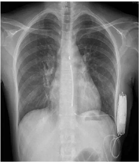 Figure 4 : Défibrillateur automatique implantable (DAI) sous-cutané [10]. 