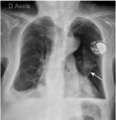 Figure 5 : Radiographie pulmonaire de face  montrant un pneumothorax gauche (flèche)  consécutif à l’implantation d’une sonde de stimulation par voie veineuse  