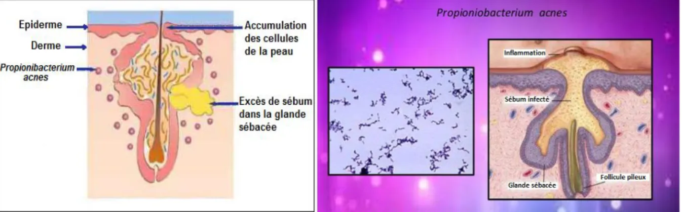 Figure 16 : Propionibacterium acnes colonisant la glande sébacée [74, 75]. 