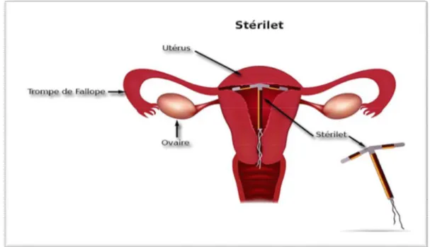 Figure 3 : Schéma d'un DIU inséré dans l'utérus [7] 