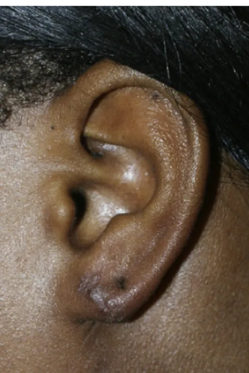 Figure 25 : Lobe d’oreille déchiré après une  déchirure traumatique due à un anneau 