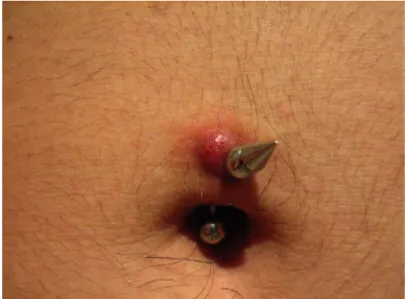 Figure 15 : Abcès auriculaire après  pose de piercing [5]. 