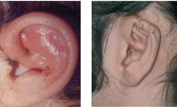 Figure 18 : Déformation de l’oreille Figure 17 : Chondrite postopératoire de l’oreille gauche, 
