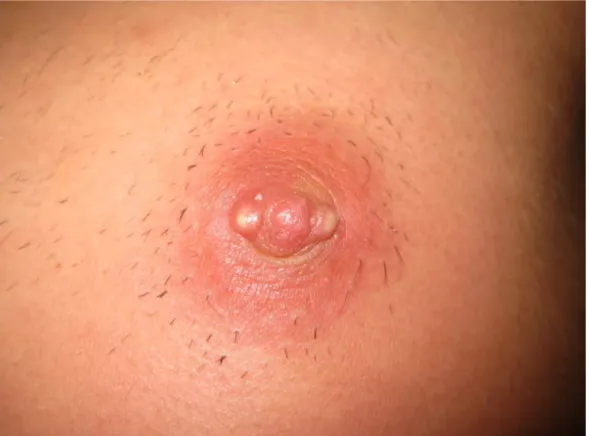 Figure 19 : Patient de 20 ans présentant un abcès après piercing du mamelon [33]. 