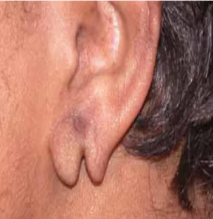 Figure 20 : Déchirure traumatique du lobe de l'oreille [30].