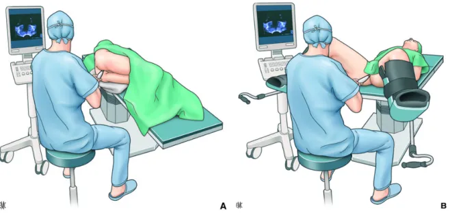 Figure 8. Exemple d’installation pour un opérateur droitier : Installation du patient en décubitus  latéral (A) ou en position de la taille (B) [61]