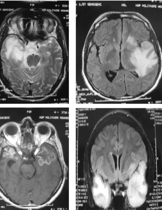 Figure 10: IRM cérébrale séquences T2 et Flair avec injection de Gado: 