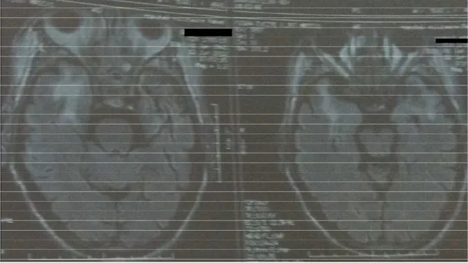 Figure 11: IRM cérébrale séquence Flair : lésions en hypersignal au niveau  temporal 