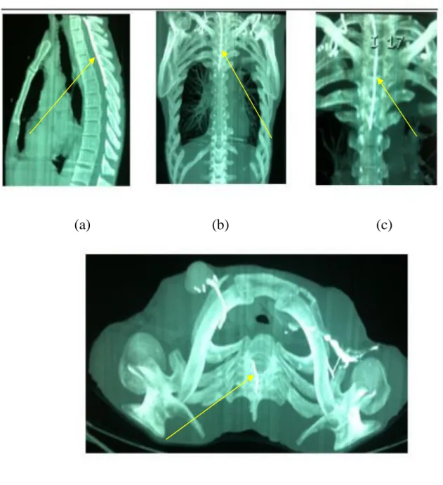 Figure 2 : TDM du rachis thoracique : (a) en coupe sagittale, (b) et (c) en coupe  coronale, (d) en 3D, montrant la présence du cathéter en intracanalaire en regard de 
