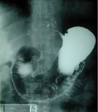 Figure 2:image radiologique d'un estomac normal avec un produit de contraste  1.1.  Rapports anatomique : 