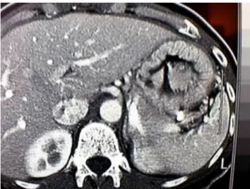 Figure 3: Image tomodensitométrique montrant   les rapports de la face antérieure de l’estomac 