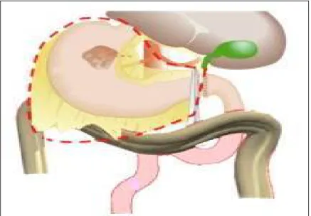 Figure 7: Gastrectomie totale 