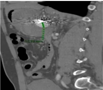 Figure 3 : Scanner en coupe sagittale montrant la recirculation du sac anévrismal  partiellement thrombosé 
