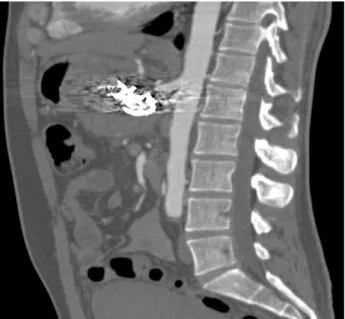 Figure 8 : scanner post-embolisation en coupe sagittale montrant l’éxclusion du faux  anévrisme sans infarctus splénique 