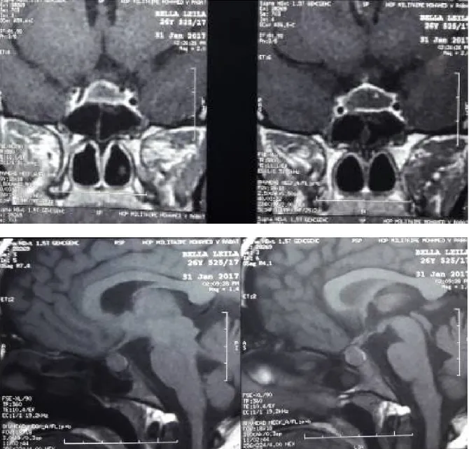 Figure 1 : glande hypophysaire augmenté de taille avec prise de contraste périphérique  évoquant un syndrome de sheehan 