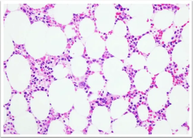 Figure 6 : Moelle hypocellulaire avec aplasie érythroïde et mégacaryocytes adéquats au  diagnostic de l'érythroblastopénie [2] 