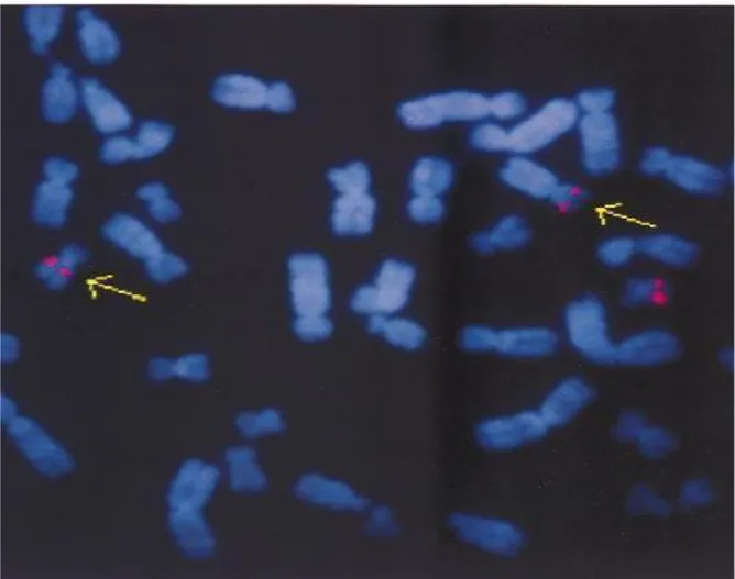 Figure 8 : Identification du point de rupture de la translocation du chromosome 19 chez  le patient atteint de t(X;19) [6] 