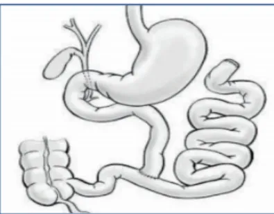 Figure 8 : un court-circuit (bypass) jéjuno-iléal 