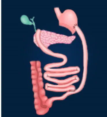 Figure 11 : Nicola Scopinaro  Figure 12 : association d’un bypass gastrique  avec une anse montée très longue et une 