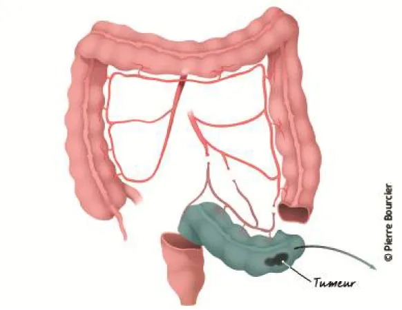 Figure 9 : Sigmoidectomie (53) 