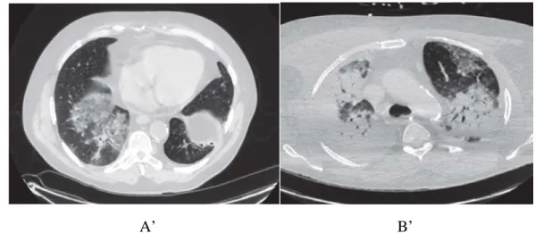 Figure 11 : TDM montrant l’évolution d’un même patient âgé de 64 ans atteint du MERS   A’ : Cliché tomodensitométrique montrant l’aspect caractéristique en verre dépoli en 24 Avril  2013