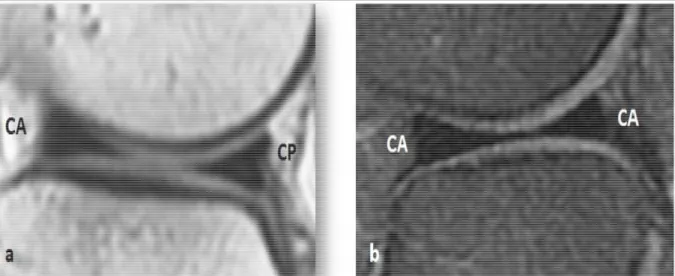Figure 14:IRM en coupes sagittales périphériques latérales en T 1 FSE (a) et DP FAT SAT FSE  (b)